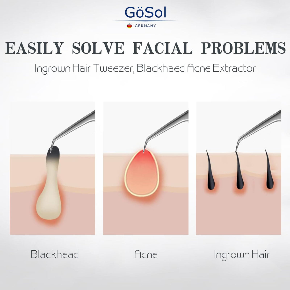 GöSol Pro Blackhead Tweezers – Precision Slant Tip for Nose & Face, Ingrown Hair Removal, Black Leather Case