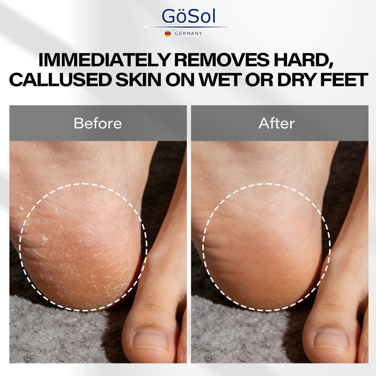 GöSol Foot Callus Remover Set – Foot File with 10 Replacements, Removes Hard & Dead Skin